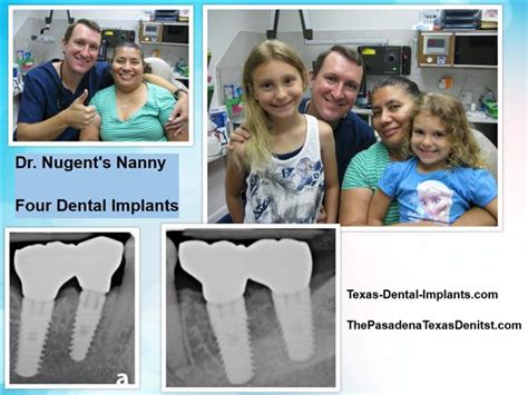 Dental Implants In Pasadena Texas Dr Michael Nugent Dds