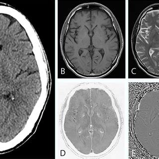 Imaging findings of a 63-year-old man with a calcified pineal gland.... | Download Scientific ...