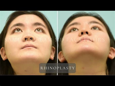 Rhinoplasty Video Testimonials Dallas Nose Surgery Plano