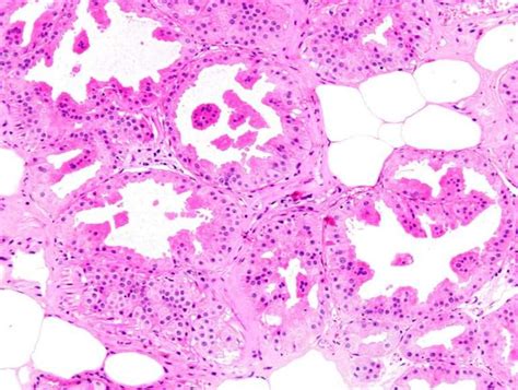 Ihc Profile Of Papillary Apocrine Metaplasia Of The Breast