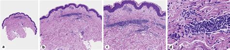 Perivascular And Interstitial Dermal Infiltrate Of Lymphocytes And Download Scientific Diagram