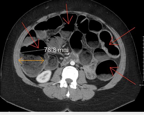 Figure 1 From Acute Large Bowel Obstruction Caused By Endometriosis