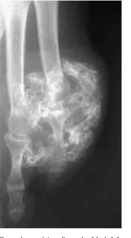 Figure From Bizarre Parosteal Osteochondromatous Proliferation Nora