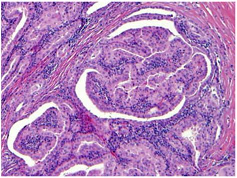 Diagnosis of Papillary Thyroid Cancer