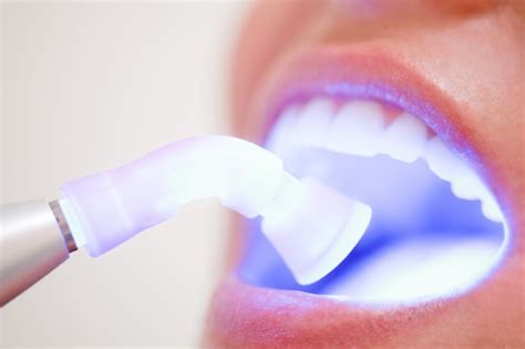 Clareamento Dental A Laser Como Funciona