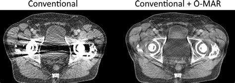 Advances In Metal Artifact Reduction In Ct Images A Review Of