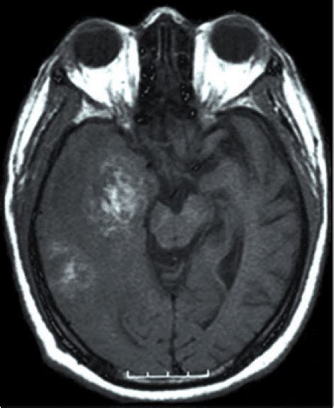 Glioblastoma Multiforme GBM