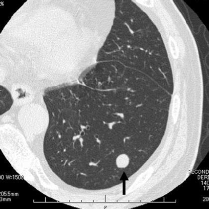 Chest CT showed an enlarged, lobulated nodule with a maximum diameter ...