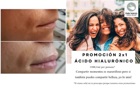 Descubre Nuestras Promociones Para Rellenoaumento Labios Con ácido