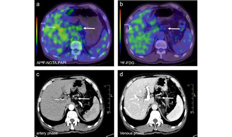 An Evaluation Of A Patient With A Local PDAC Al 18 F NOTA FAPI 04