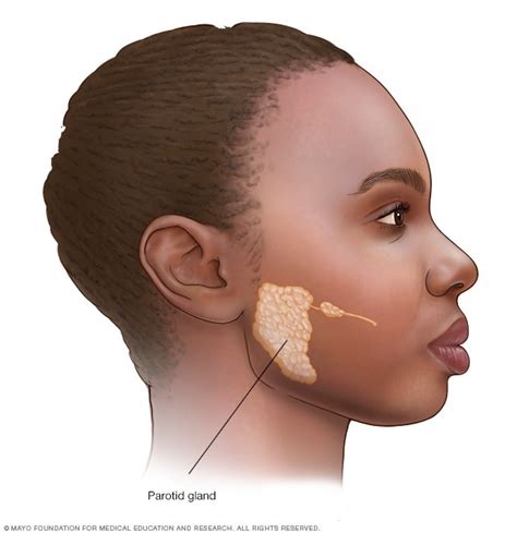 Parotid Gland Tumor Symptoms