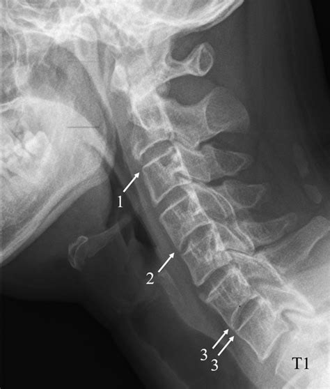 Cervical Ankylosing Spondylitis X Ray