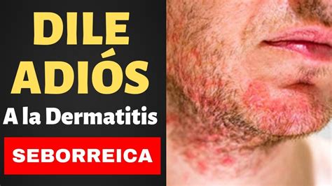 Remedios Caseros Para La DERMATITIS SEBORREICA Tratamientos Para La