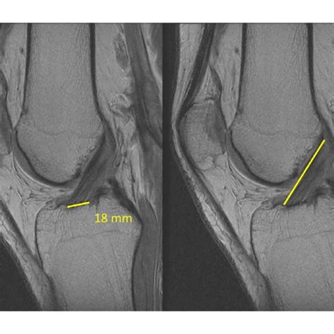 Determination Of Femoral Tunnel Angle On Posterior Anterior 45° Download Scientific Diagram