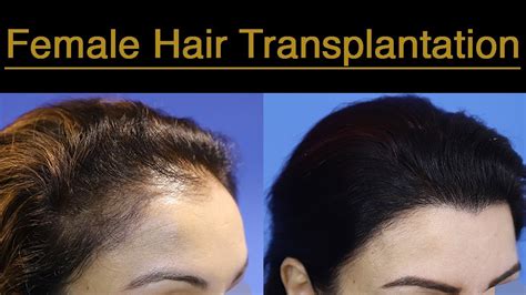 Natural Looking Hairline Restoration In Female Hair Transplantation 1500 Grafts 12 Months