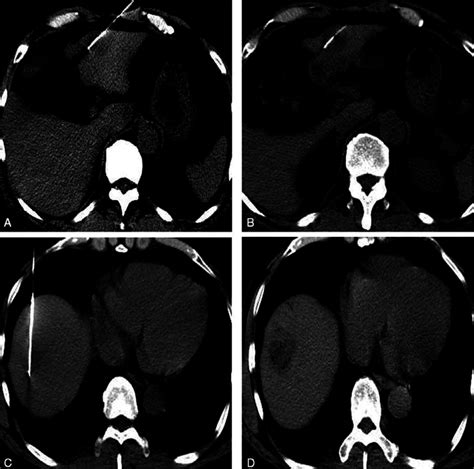 Additional ablation of other lesions in the liver. RFA ablation was ...