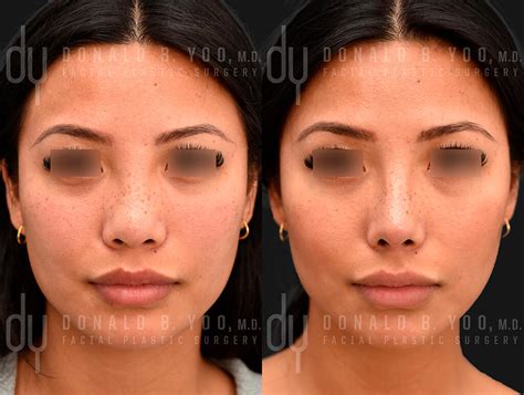 Asian Nose Job Before And After