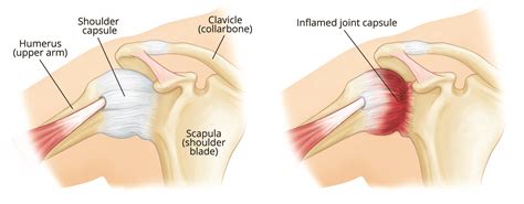 Frozen Shoulder - Adhesive Capsulitis - shoulder surgeon in seattle