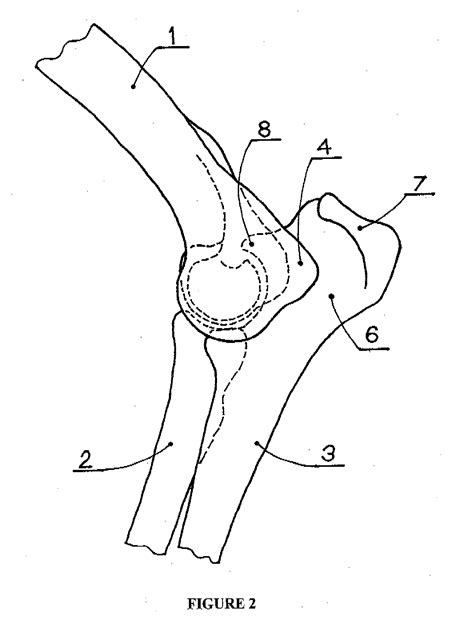 Elbow Joint Prosthesis And Method For Implantation Eureka Patsnap