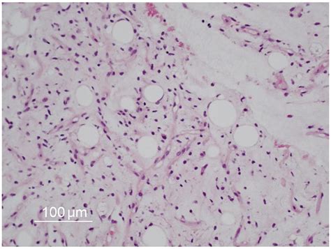 Myxoid Liposarcoma With EWSCHOP Type 1 Fusion Gene Anticancer Research