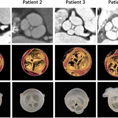 Anatomical Structures Of The Quadricuspid Aortic Valves Of Five