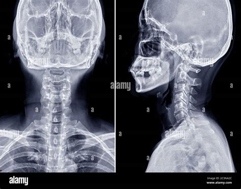 Radiograf A Del Cuello De V Rtebras Cervicales Fotograf As E Im Genes