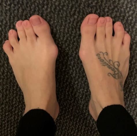 Hallux Valgus Beide F E Gleichzeitig Operieren Ortho Pede