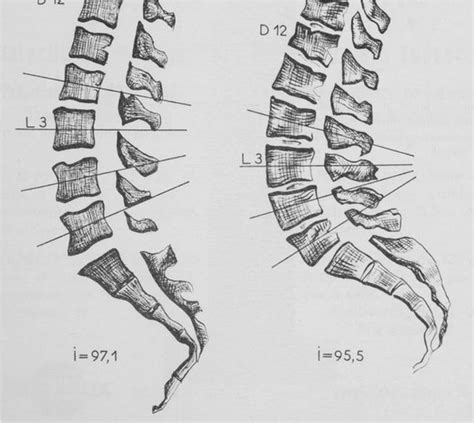 6 Spinal Curves Segmentation and Lumbar Lordosis Classification ...