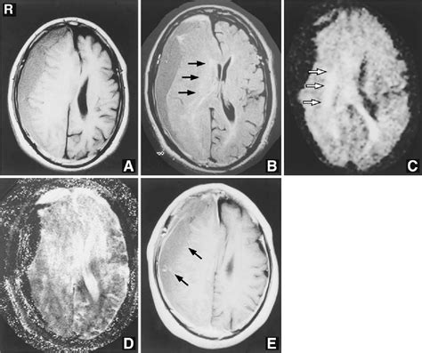 Figure From Chronic Subdural Hematoma With Vasogenic Edema In The