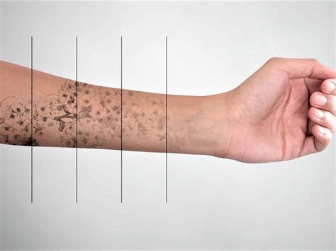 C Mo Eliminar Tatuajes Eficazmente Con L Ser Todo Lo Que Debes Saber