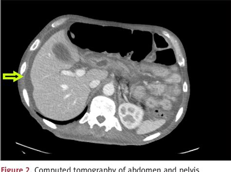 Figure 2 From A 53 Year Old Man Presenting With Pancreatic Exocrine Insufficiency 7 Years After