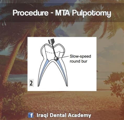 Pulpotomy Procedure For Pediatrics In Detail