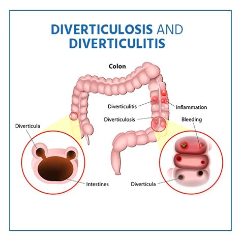 Diverticulitis Síntomas Causas Y Tratamiento