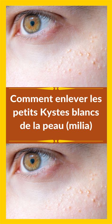 Comment Enlever Les Petits Kystes Blancs De La Peau Milia Monmag Artofit