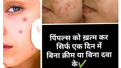 How To Remove Pimples Overnight Acne Treatment At Home Pimple