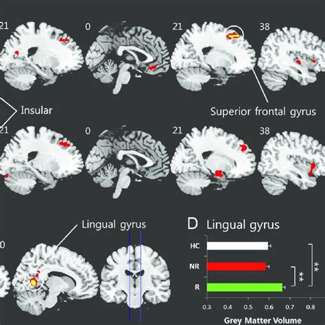 Gray Matter Gm Volume Changes From Group Analysis A Statistical