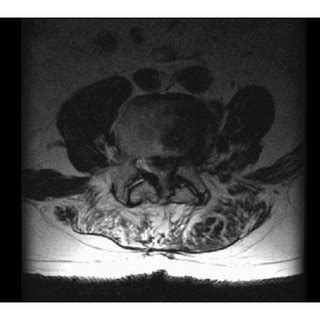 Noncontrast CT Scan Of The Brain Displaying Significant Pneumocephalus