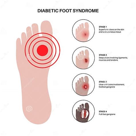 Diabetic Foot Ulcers stock vector. Illustration of patient - 287520846