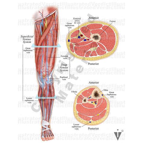 Stock Lower Limb Vasculature Illustrated Verdict