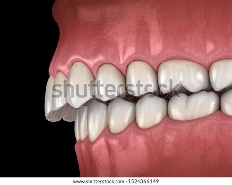 Overbite Dental Occlusion Malocclusion Teeth Medically Stock