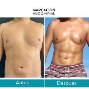 Marcación Abdominal en Bogotá Dr Leonardo Rueda