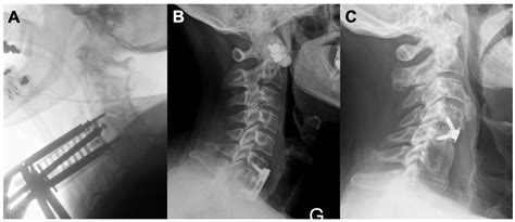 Clinical Outcomes between Stand-Alone Zero-Profile Spacers and Cervical