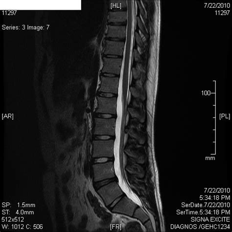 Albums 97 Pictures What Does A Herniated Disc Look Like On An Mri Updated