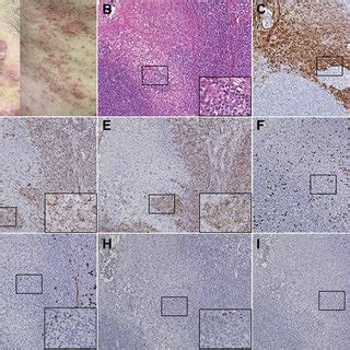 Percentage And Distribution Of Folliculotropic Mycosis Fungoides