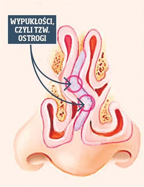 Jak Naprawi Krzyw Przegrod Nosa