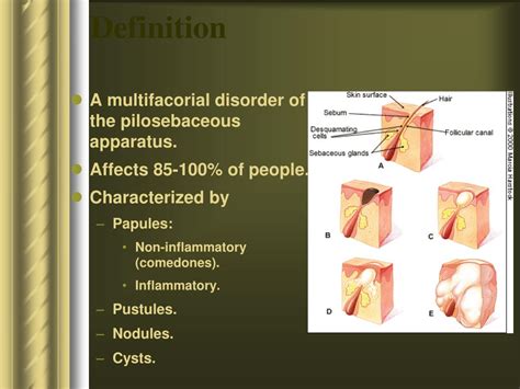 Ppt Disorders Of Sebaceous Glands Powerpoint Presentation Free Download Id694078