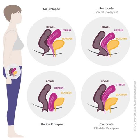 Pelvic Organ Prolapse And Why Kegels Arent Enough Mutu System In