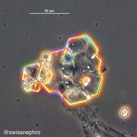 Cystine Crystals In Urine