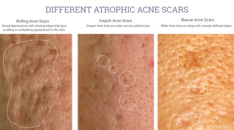 Acne Scar Treatments Remove Marks Left By Pimples Dr Harold Ma