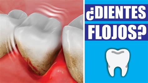 DIENTES FLOJOS QUÉ HACER ENFERMEDAD PERIODONTAL Dr SANTIAGO